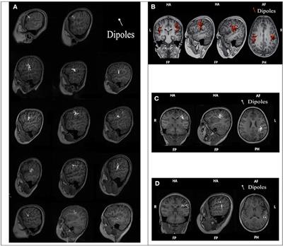 The Correlation of ELP4-PAX6 With Rolandic Spike Sources in Idiopathic Rolandic Epilepsy Syndromes